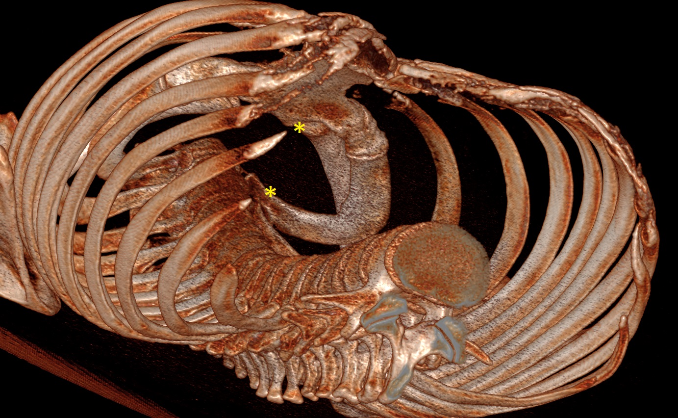 Ricostruzione Tc Torace 3D che mostra le punte costali libere della X-XI costa 