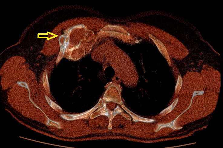 TAC Torace che mostra una displasia fibrosa gigante 