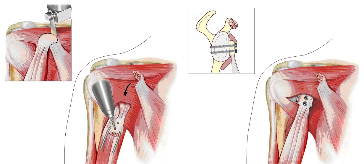 Fig. 4 - Tecnica di capsuloplastica secondo Latarjet.