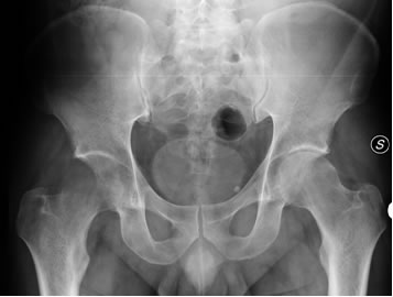 Fig 1 Edema transitorio della testa del femore destro alla radiografia