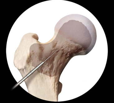 Fig 3 Infiltrazione percutanea di concentrato di cellule stromali autologhe sotto controllo radiografico