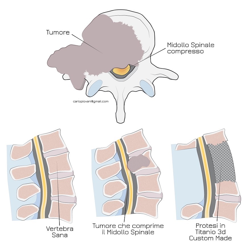  Top left: Tumor. Top right: Compressed spinal midol. Botton, from left to right: healthy vertebra; tumor compressing the spinal midol; costum-made 3d titanium prosthesis