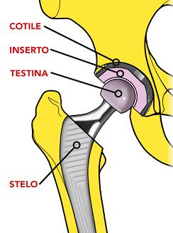 Hip prosthesis: illustration of the different components (cotyle, insert, head, stern)