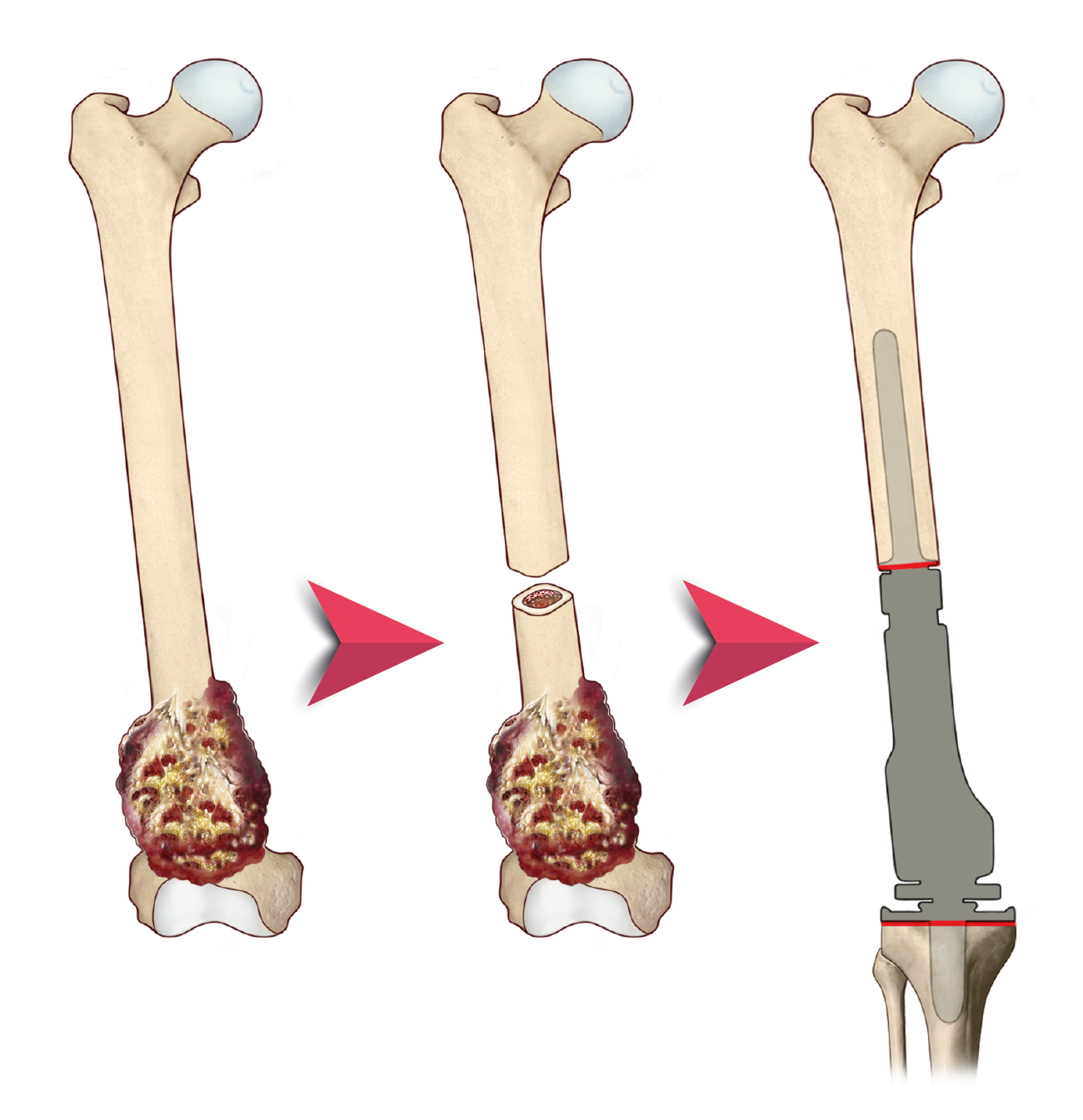 Image: surgery and reconstruction of the affected tissue