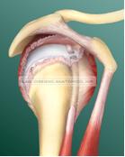 Fig. 4 – Lesione massiva