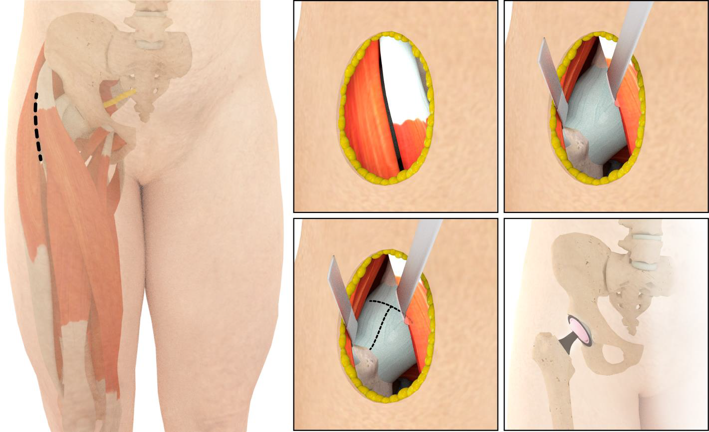 Fig. 3 - Accesso anteriore