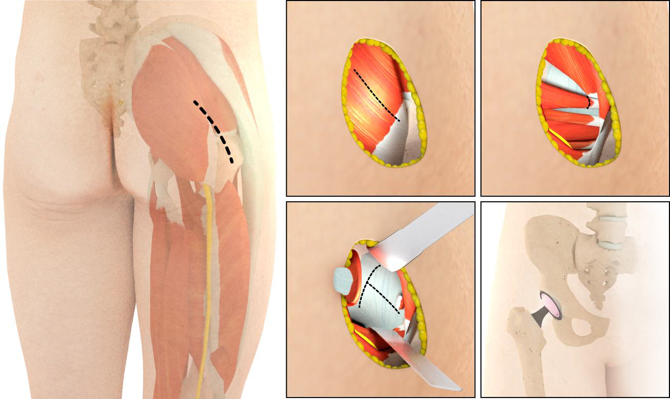 Fig. 4 - Accesso postero-laterale