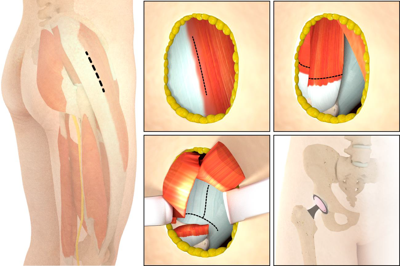 Fig. 5 - Accesso antero-laterale