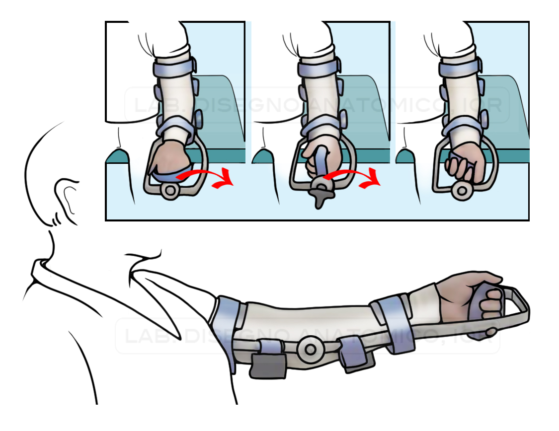 Fig. 11 - Tutore di Mobilizzazione