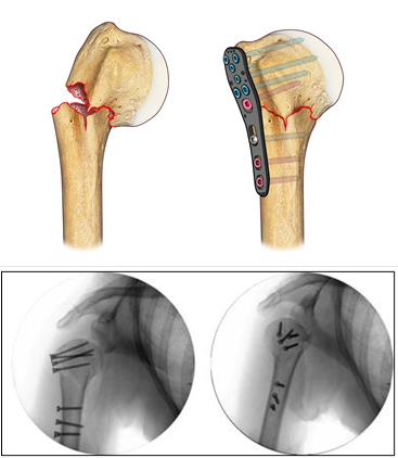 Fig.7: Placca in materiale plastico (PEEK), radiotrasparente (migliora la visibilità della frattura) e viti in titanio (avvitate sulla placca oltre che nell’osso, per una maggior tenuta)