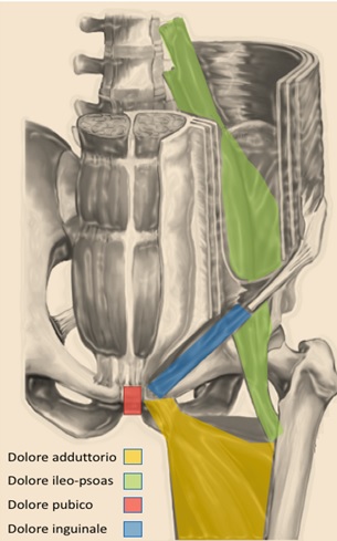 1. Distinzione delle strutture anatomiche coinvolte nella Sindrome del Dolore all'Inguine (Groin Pain Syndrome)