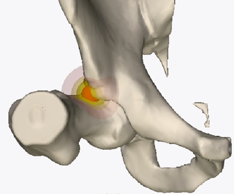 6. Esempio di modello tridimensionale, con simulazione dell’area di conflitto femoro-acetabolare